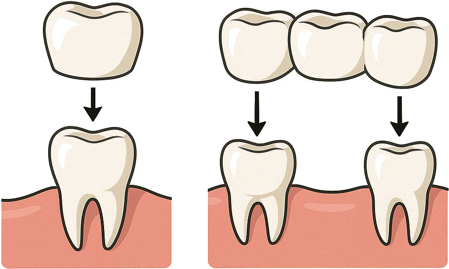 custom crowns and bridges